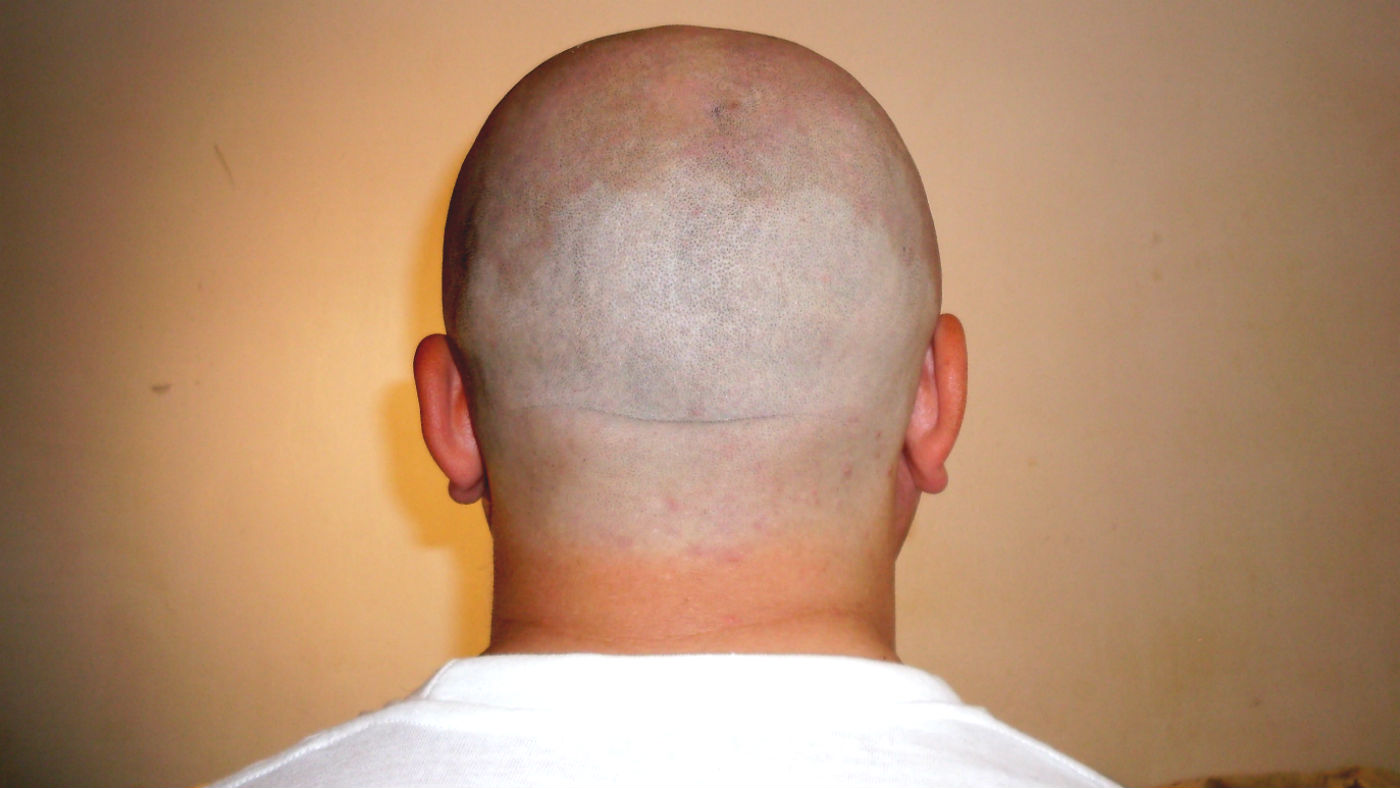 Brittle bone drug could unlock cure for baldness | The Week UK