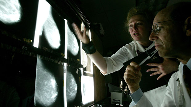Doctors look at films of breast cancer X-rays