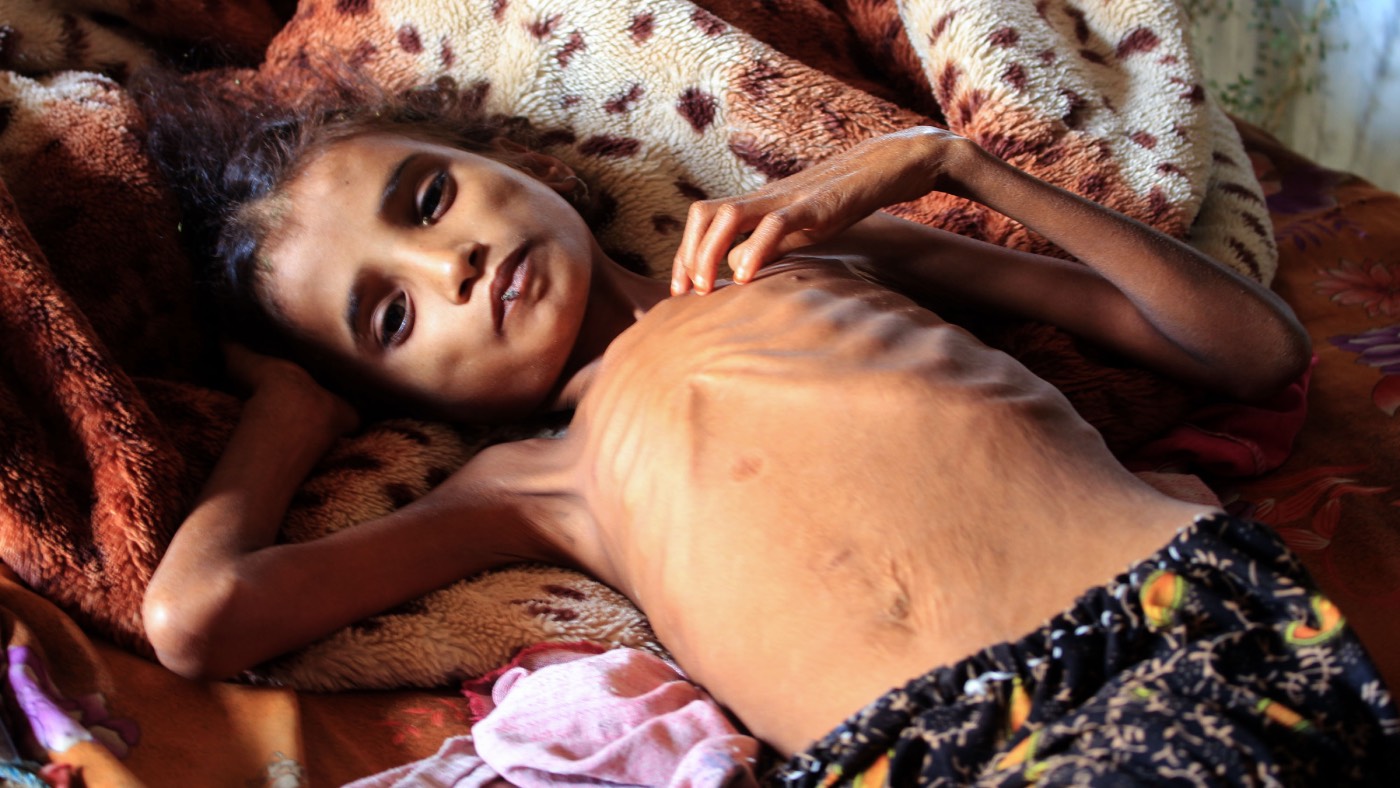 Starving Yemeni child
